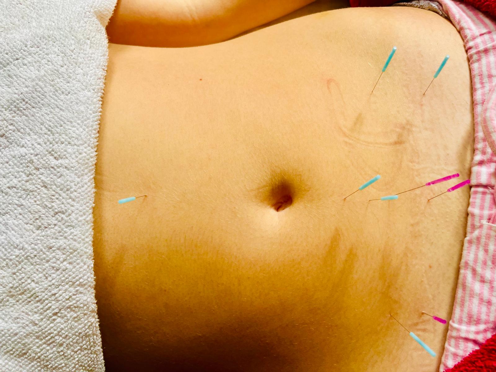Acupuncture & PCOS: Louise’s Journey to Hormonal Balance By Barbara Moss